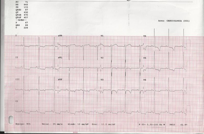 ECG-1