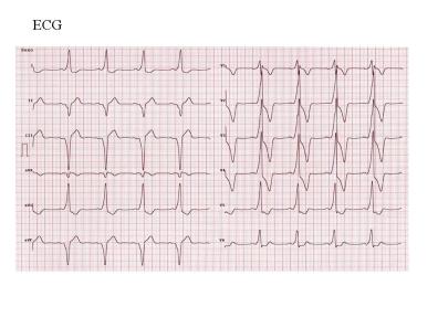 ECG-CASO 3