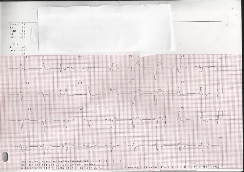 ECG-1