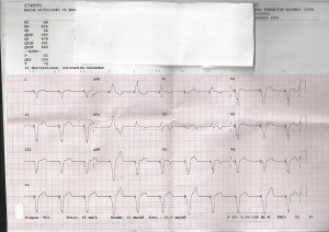ECG-2