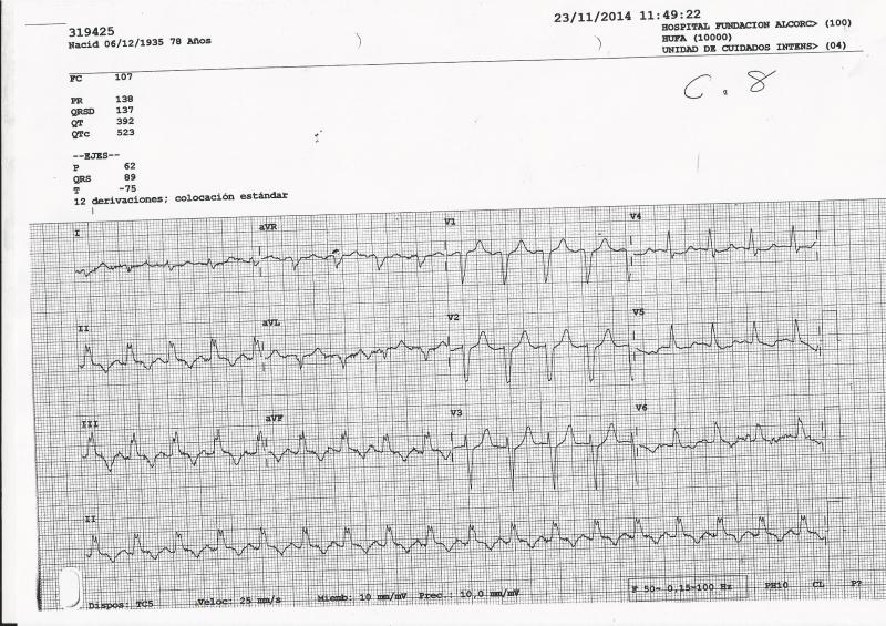 ECG-IAM-BRI