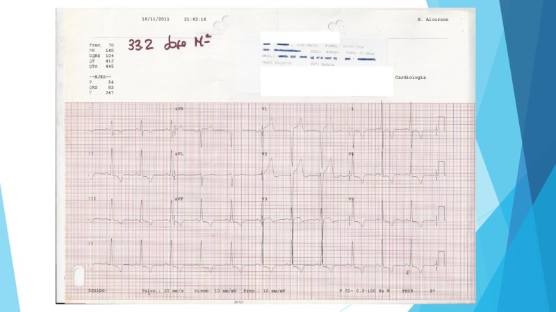 ECG HVI-2