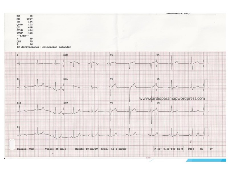 ecg-normal-tras-cx