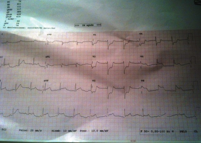 ECG-Espasmo-1