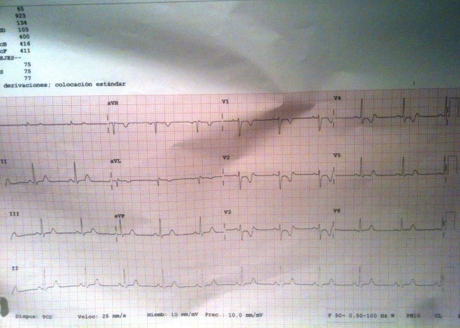 ECG-Espasmo-2