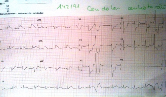 ECG-Espasmo-4