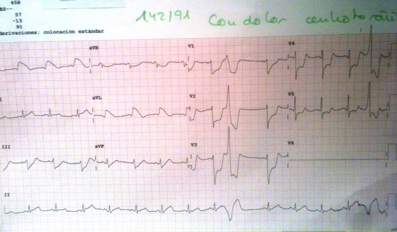 ECG-Espasmo-4