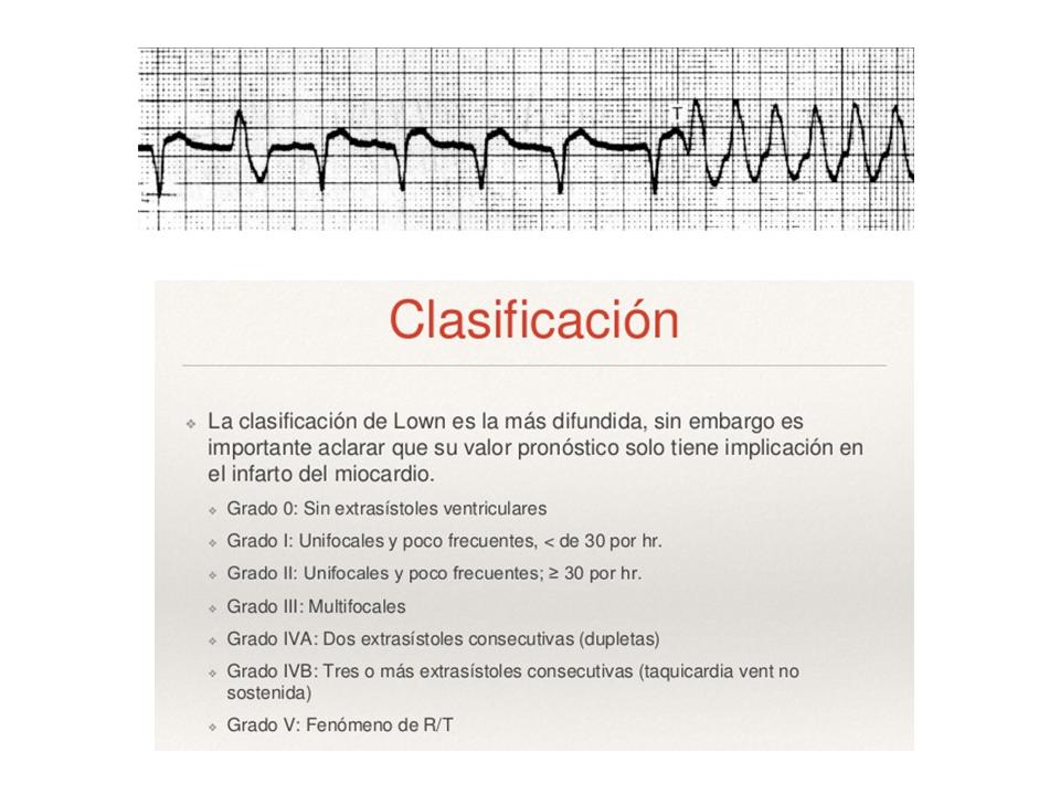 Clasificación de Lown y Fen RsobreT