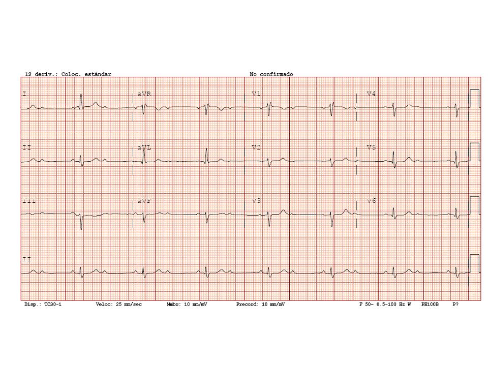 bloqueos-av-2o-grado-tipo-ii-2