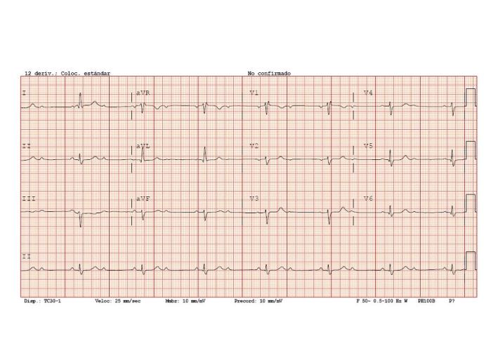 bloqueos-av-2o-grado-tipo-ii-2