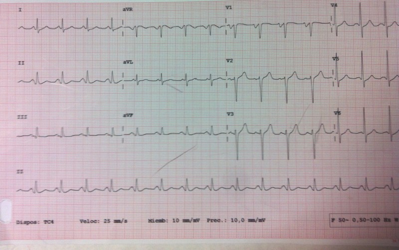 ecg-tras-cve