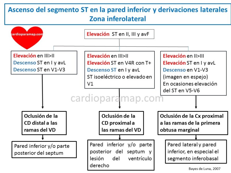 localiza-la-arteria-del-infarto