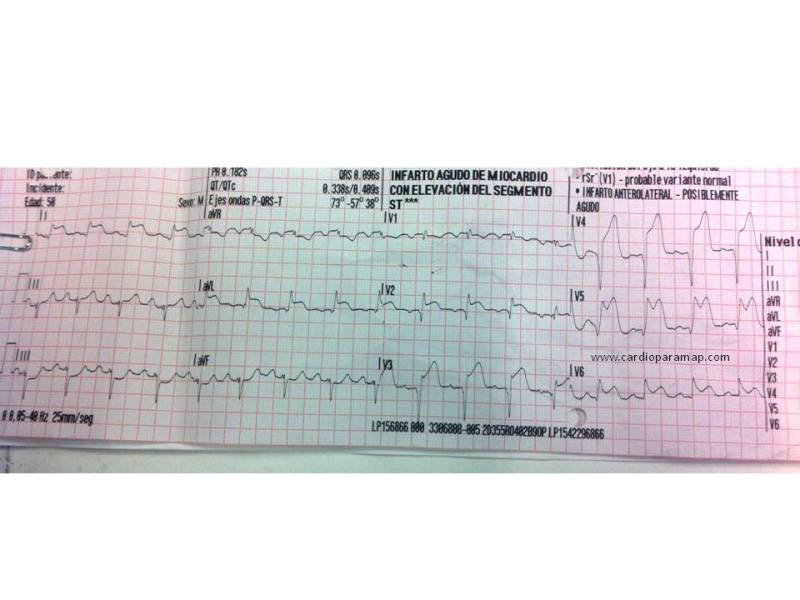 ECG Summa modificado