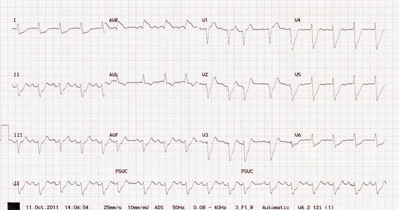 ECG Elevación ST en AVR-2