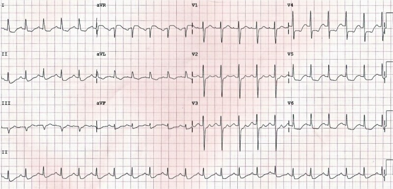 ECG ELEVACION ST EN AVR
