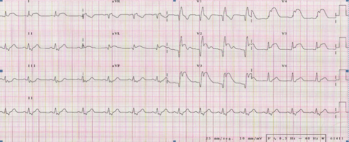 IAM ANTERIOR Y BRDCHA