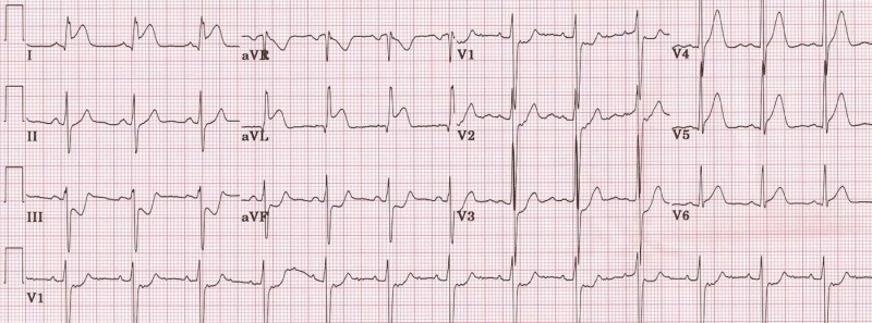 lateral-IAM -1st-diagonal
