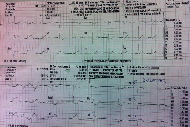 ecg-de-iam-inferior