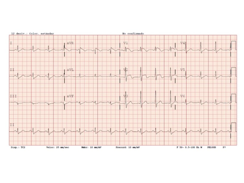 SÍndrome de Brugada