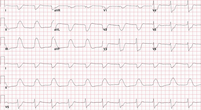 SHARK FIN ECG