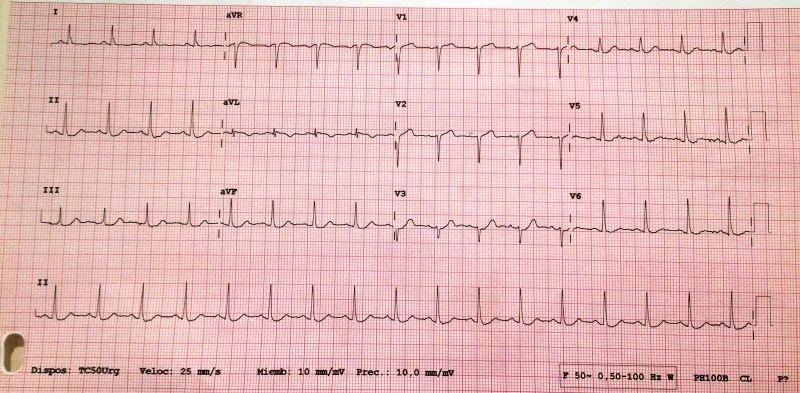 ECG Urgencias
