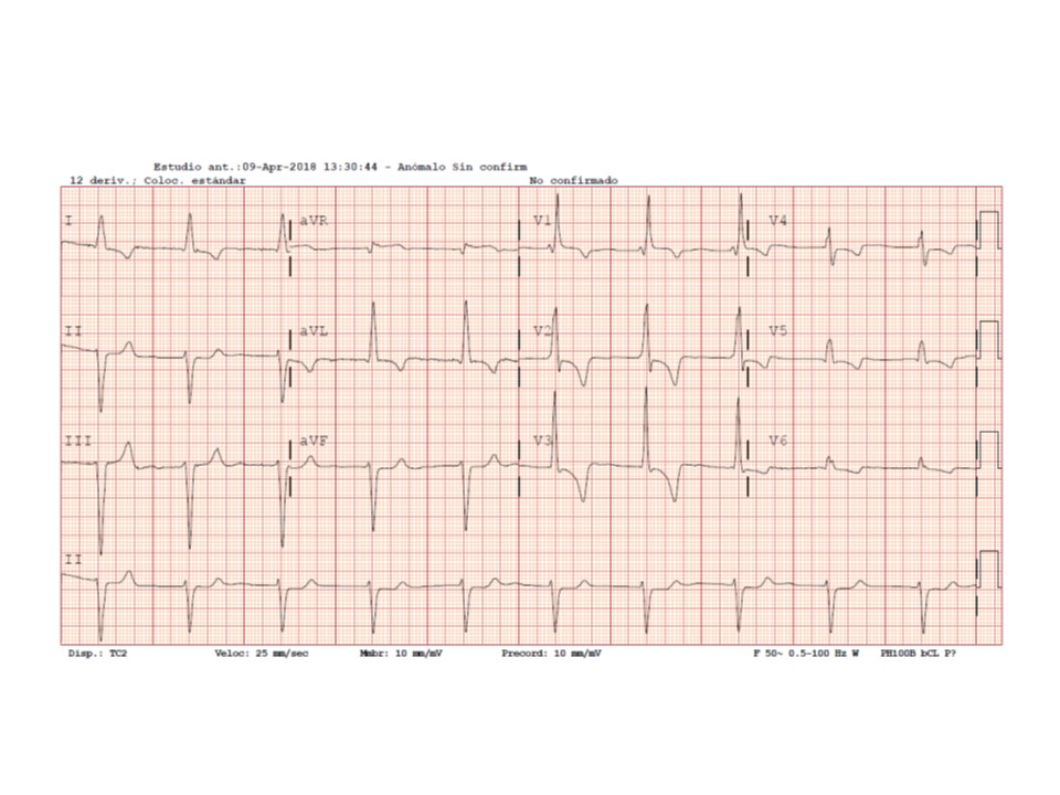 ECG HVDcha